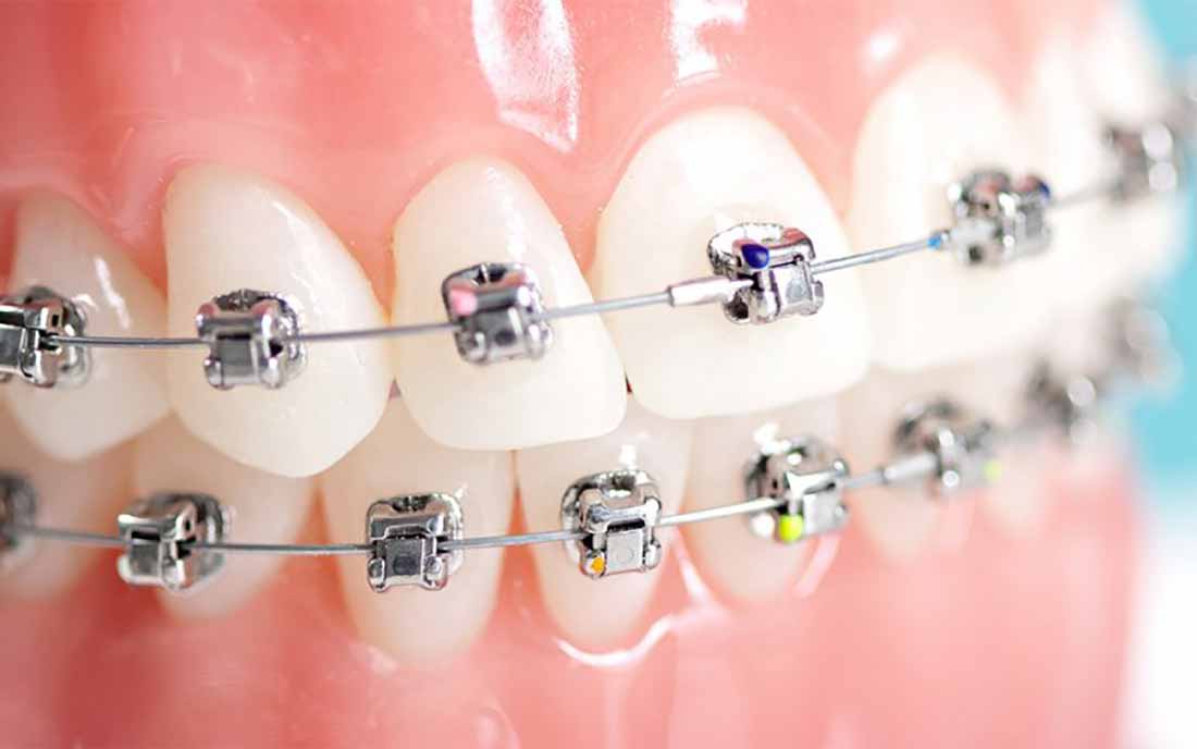 Sabit Ortodontik Tedavi