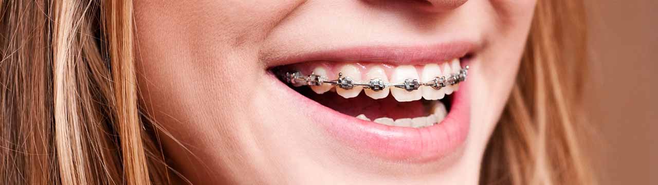 Şeffaf Plak Tedavisi (Telsiz Ortodonti)
